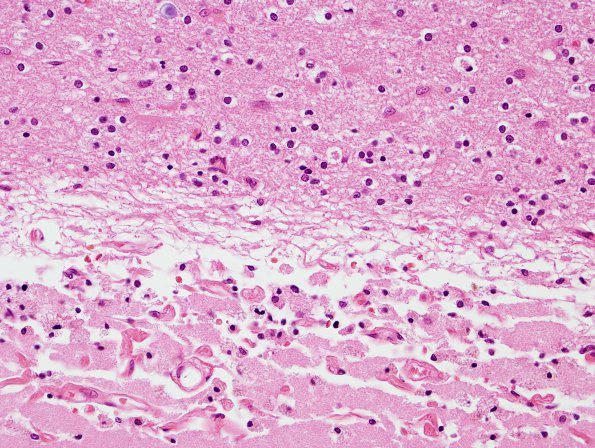 1C4 Laminar necrosis (Case 1) N19 H&E 2