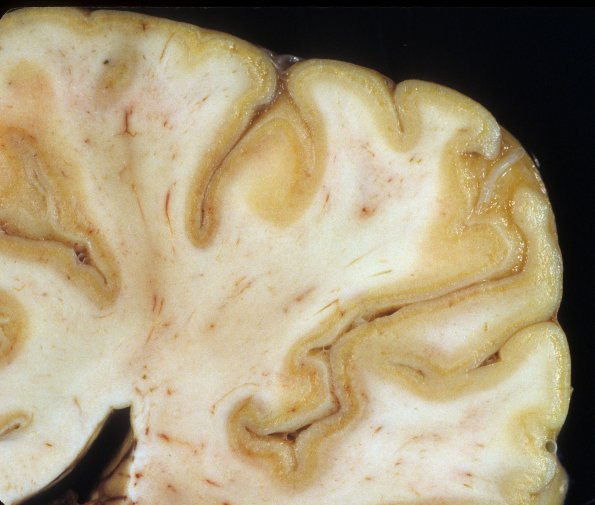 2A5 Laminar necrosis (Case 2) A3