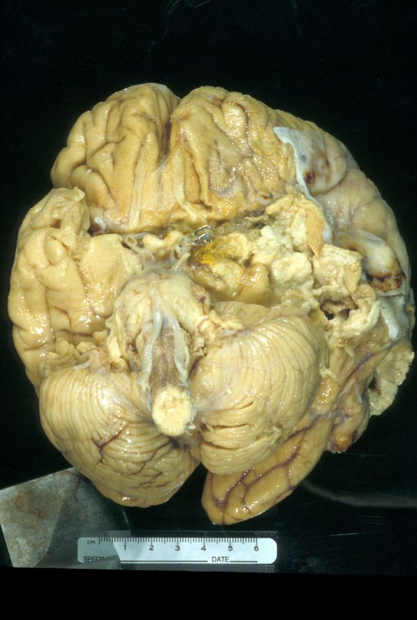 4A1 Aneurysm (Case 4) sp clipping gross 1