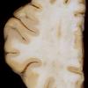 4A3 Aneurysms, laminar necrosis (Case 4) A8