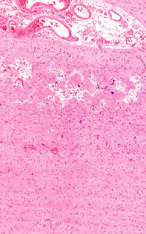5A4 Laminar necrosis (Case 5) 20X 2