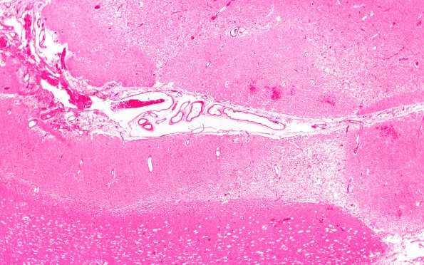 6B2 Laminar necrosis (Case 6) L H&E 2X