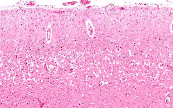 6B3 Laminar sclerosis (Case 6) H&E 10X 1