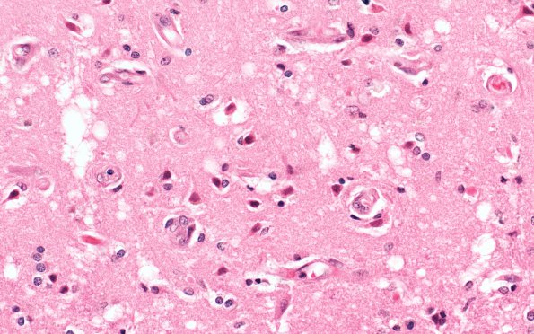 6B4 Laminar sclerosis (Case 6) H&E 40X