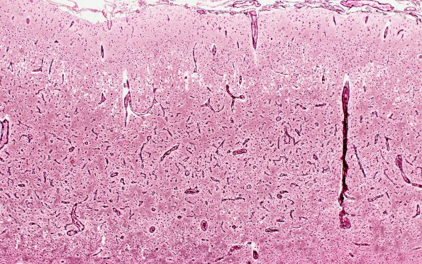 6D2 Laminar sclerosis (Case 6) Retic 2