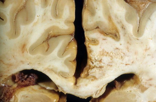 7A1 Infarct, sp ACA aneurysm rupture & laminar (Case 7)