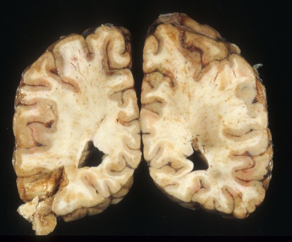 8A1 Laminar necrosis, Sinus thromboses (Case 8) 9