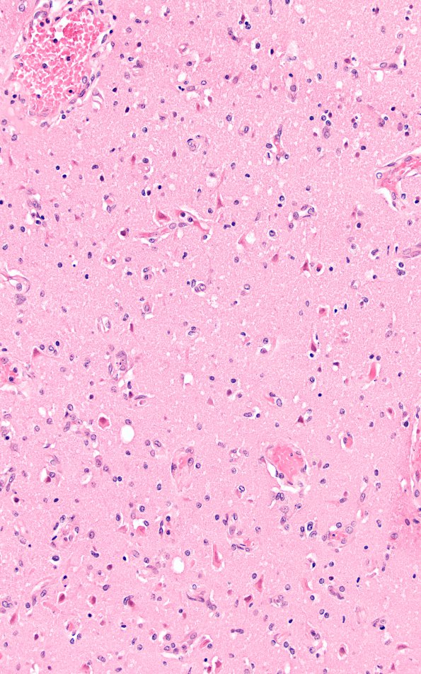 8B5 Case 8 N1L H&E 11269