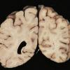 9A1 Infarct, laminar (Case 9) N22 gross_5 copy