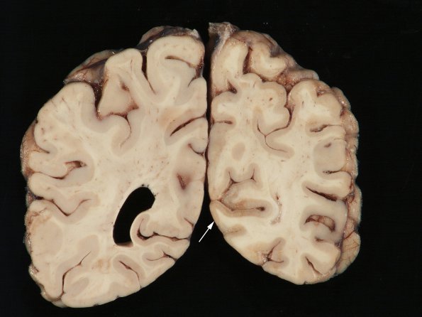 9A1 Infarct, laminar (Case 9) N22 gross_5 copy