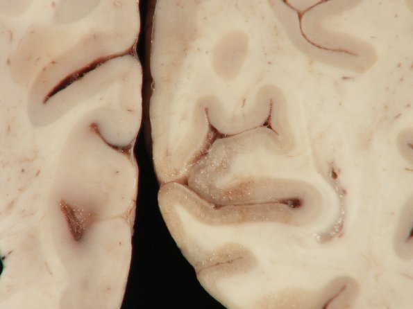 9A2 Infarct, laminar (Case 9) N22 gross_6