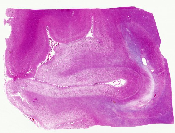 9B1 Infarct, laminar (Case 9) N22