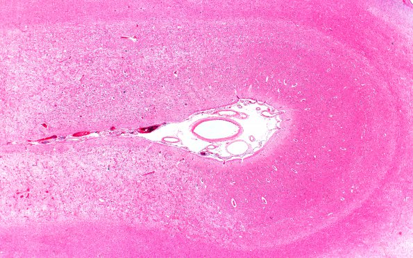 9B2 Infarct, laminar (Case 9) N22 11257 2