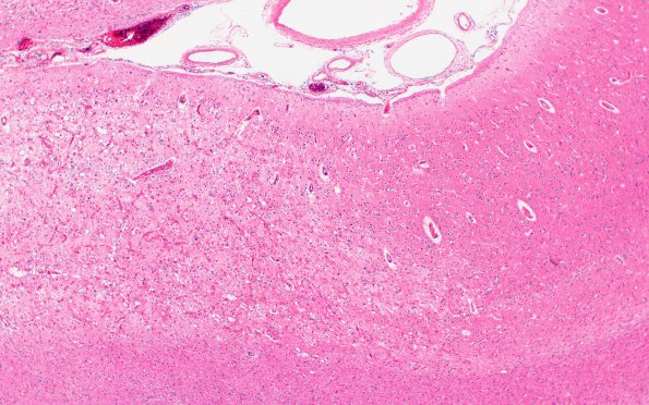 9B3 Infarct, laminar (Case 9) N22 11257