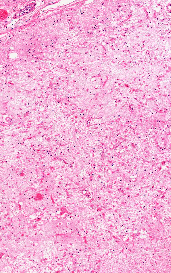 9B4 Infarct, laminar (Case 9) N22 11258