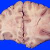 10A1 Infarct, acute (Case 10) gross