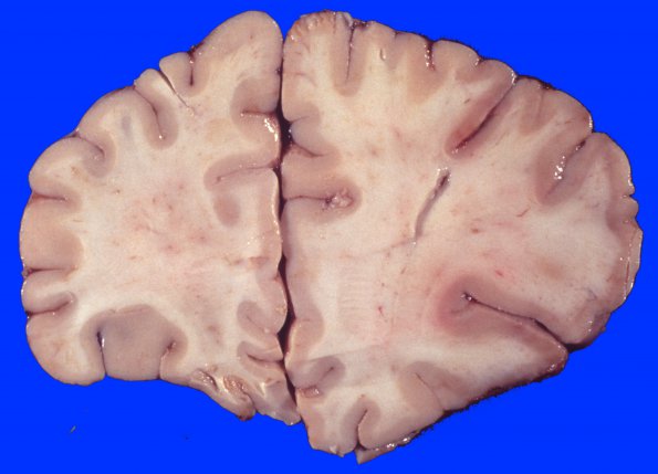 10A1 Infarct, acute (Case 10) gross