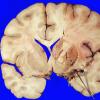 10A2 Infarct, recent (Case 10) original slide