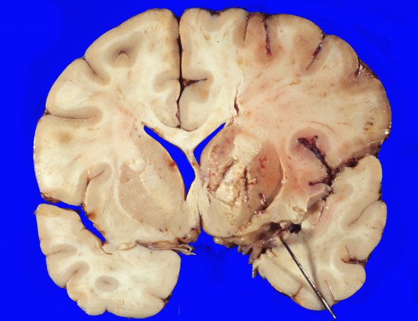 10A2 Infarct, recent (Case 10) original slide