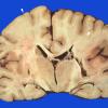 10A3 Infarct, embolic (Case 10) NBTE gross 1 copy