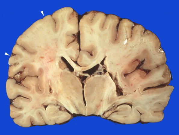 10A3 Infarct, embolic (Case 10) NBTE gross 1 copy