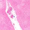 10B3 Infarct, embolic (Case 10) SFG A H&E 4X copy