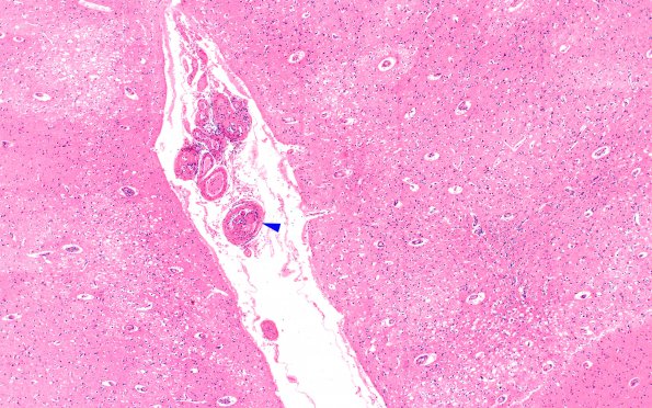 10B3 Infarct, embolic (Case 10) SFG A H&E 4X copy