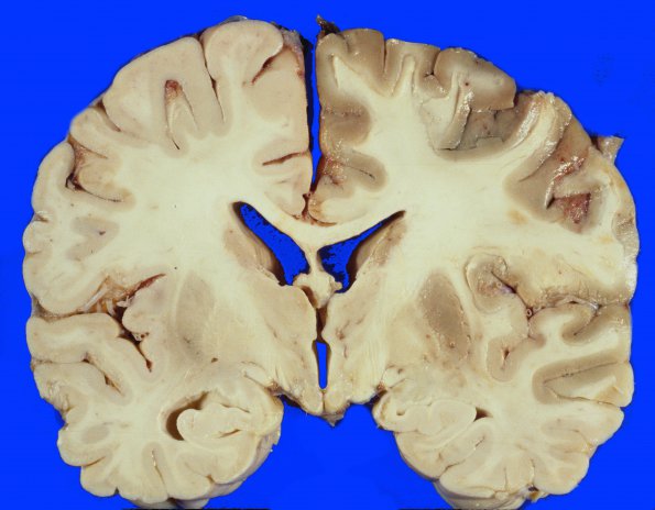 11A1 Infarct, Acute (Case 11) 1