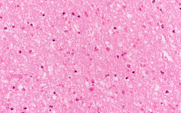 12A3 Infarct, acute, white matter (Case 12) N16 H&E white matter