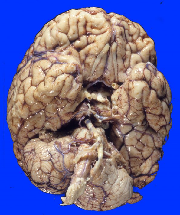 1A1 Infarct, basilar thrombosis, acute (Case 1) 2