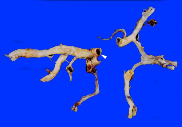 1A2 Infarct, basilar thrombosis, acute (Case 1) 1 copy