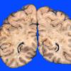 1A3 Infarct, basilar thrombosis, acute (Case 1) 5