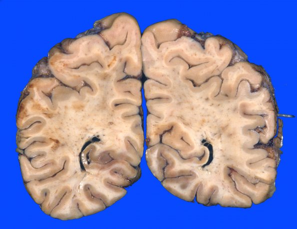 1A3 Infarct, basilar thrombosis, acute (Case 1) 5