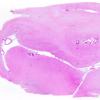 1B3 Infarct, Acute (Case 1) N5 H&E WM