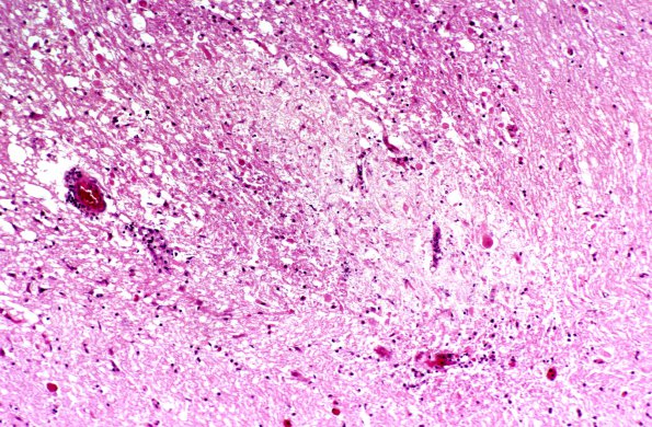 1B4 Infarct, acute (Case 1)