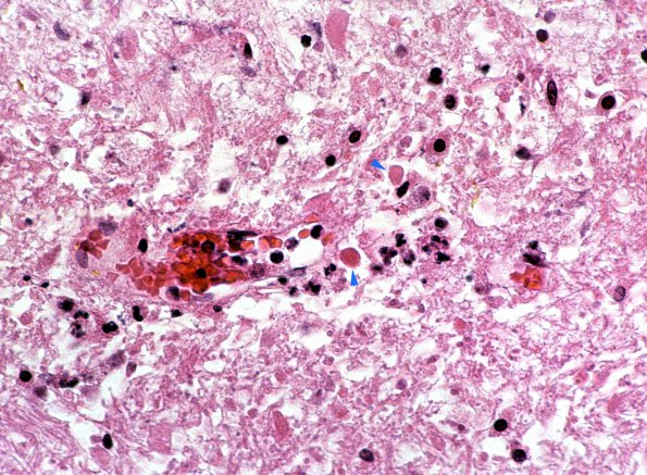 1B5 Infarct, acute (Case 1) 68baa copy