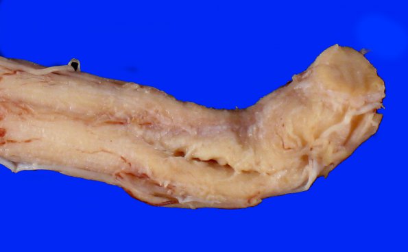 2A1 Infarct, spinal cord (Case 2) A_4