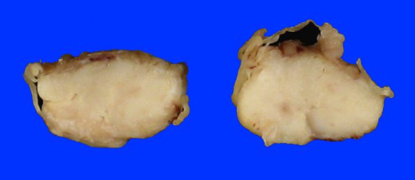 2A2 Infarct, spinal cord (Case 2) A_6