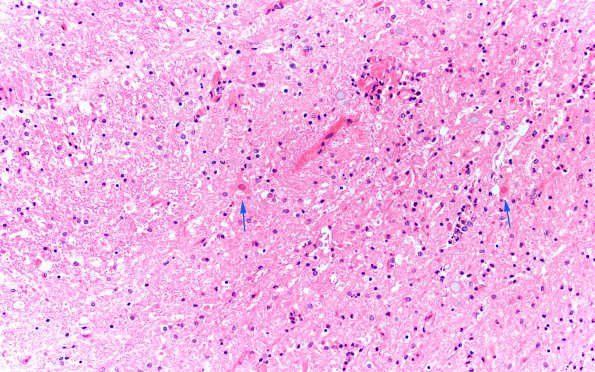 2B3 Infarct, Acute (Case 2) N10 H&E  Anterior horn 20X copy