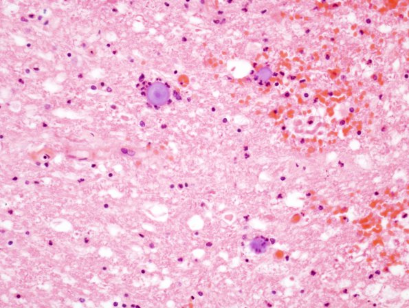 2B5 Infarct, Acute (Case 2) Corpora Amylacea