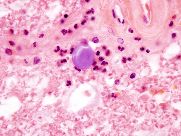 2B6 Infarct, Acute (Case 2) Corpora Amylacea 2