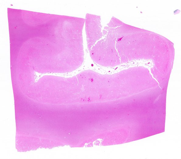 3B1 Infarcts, Watershed, Acute (Case 3) N13 H&E WM