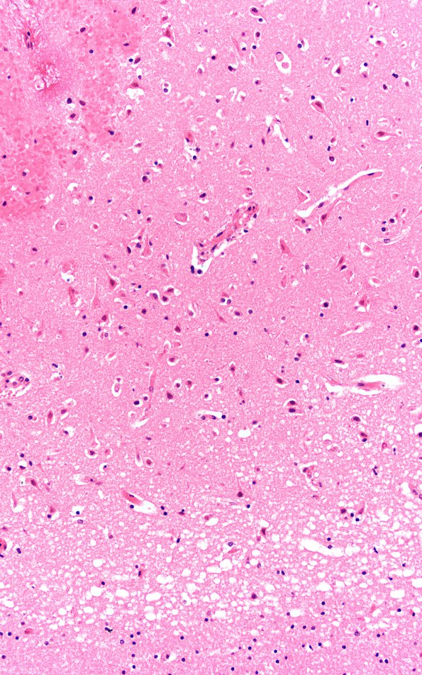 3B3 Infarcts, Watershed, Acute (Case 3) N13 H&E 20X