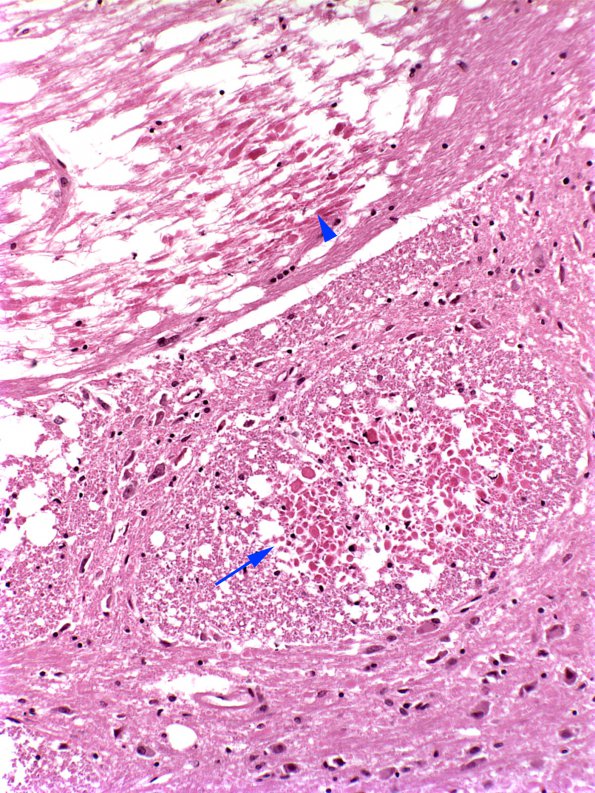 4A4 Infarct, Lacunar (Case 4)c copy