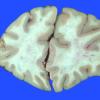 5A1 Infarct, acute (Case 5) _4