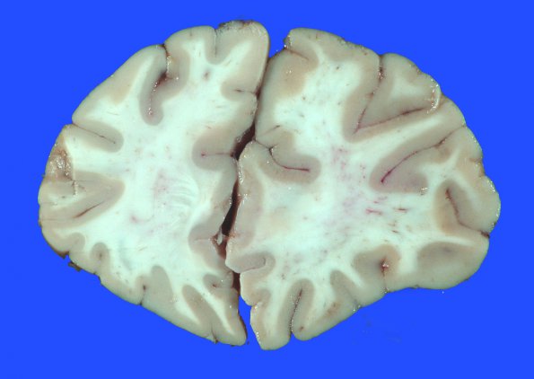 5A1 Infarct, acute (Case 5) _4