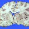 5A2 Infarct, acute (Case 5) _7