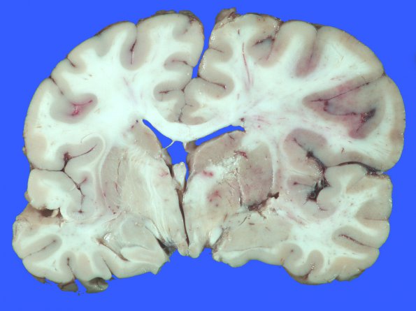 5A2 Infarct, acute (Case 5) _7