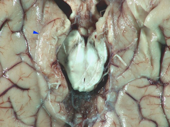 5A3 Infarct, acute (Case 5) uncal herniation 3 copy