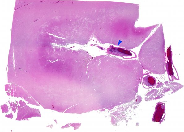 5B1 Infarct, recent (Case 5) MCA-ACA infarct H&E WM 2 N16 copy